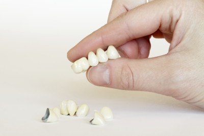 Porcelain crown restoration