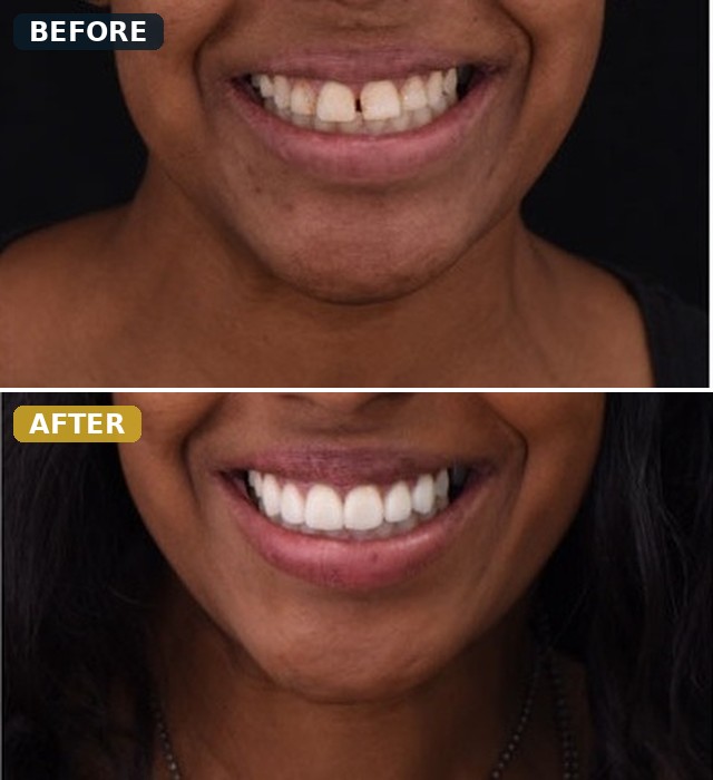 Before and after smile transformation, case 1