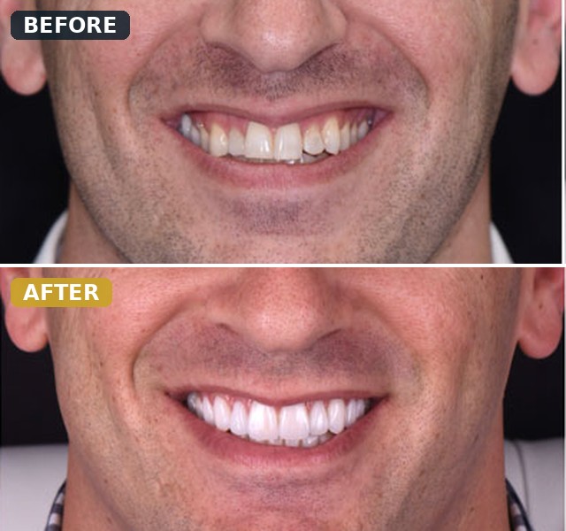 Before and after smile transformation, case 2
