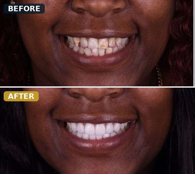 Before and after smile transformation, case 3