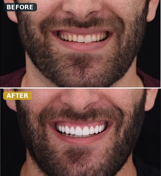 Before and after smile transformation, case 4