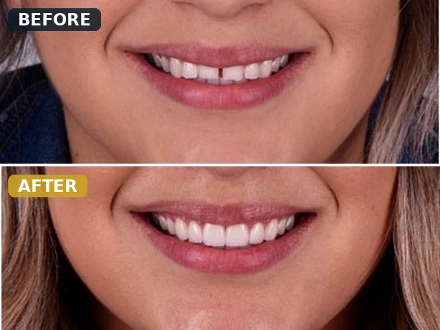 Before and after smile transformation, case 5