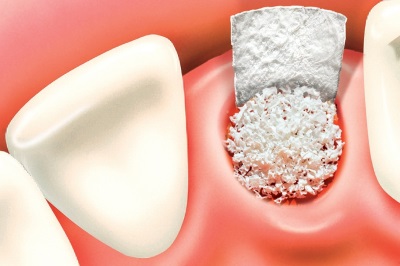 Bone Graft