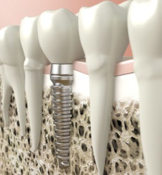 Dental Implants