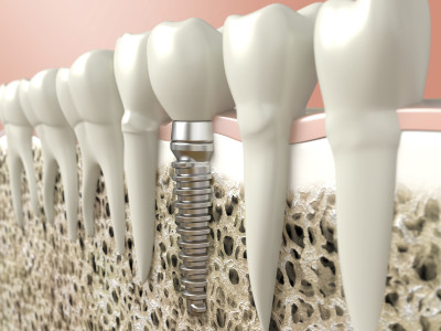 Implantes dentales