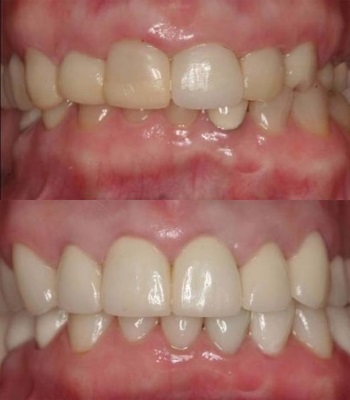 Gum Therapy at Linden Dental Associates