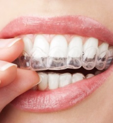 Clear Aligners