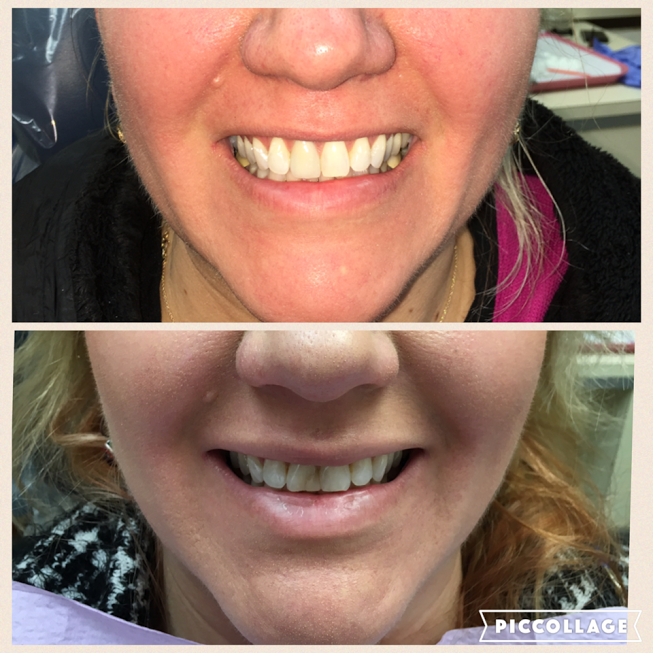 More before and after results