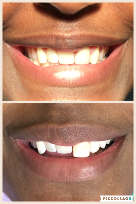 Collection of before and after smiles