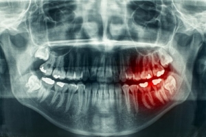 Traumatic Dental Injuries