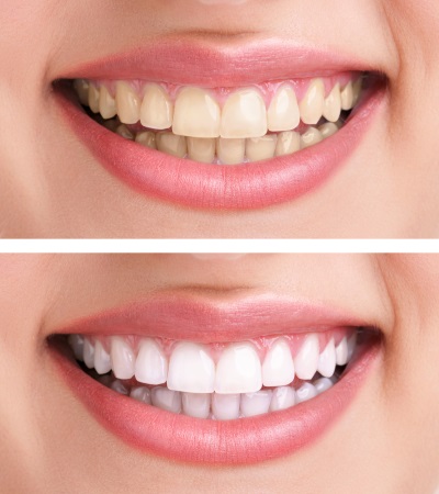 Zoom whitening before and after comparison